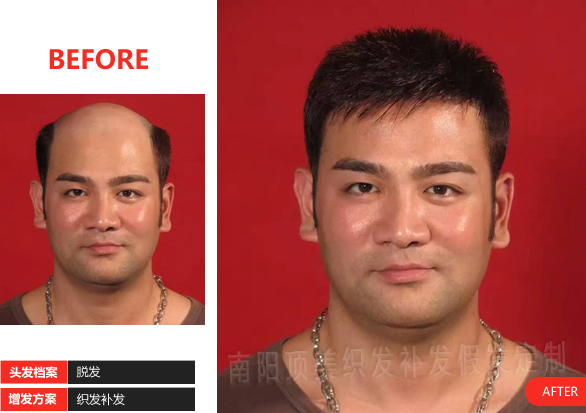男士補發(fā)案例