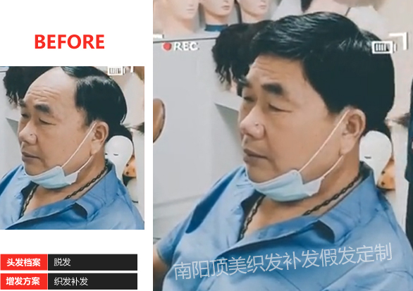 南陽(yáng)頂美中老年假發(fā)補發(fā)案例視頻